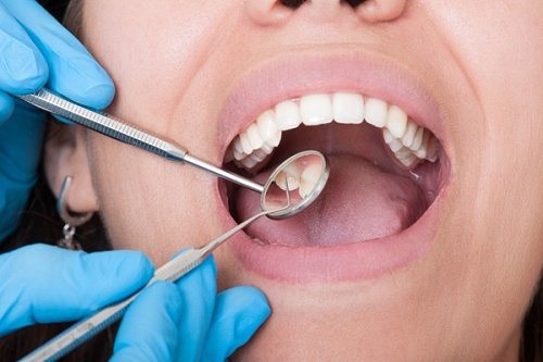 Viêm lợi, viêm chân răng là tác nhân gây hôi miệng