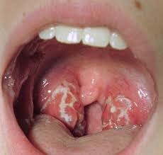 viêm họng là nguyên nhân gây hôi miệng