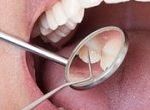Viêm lợi, Viêm chân răng dẫn đến tình trạng hôi miệng